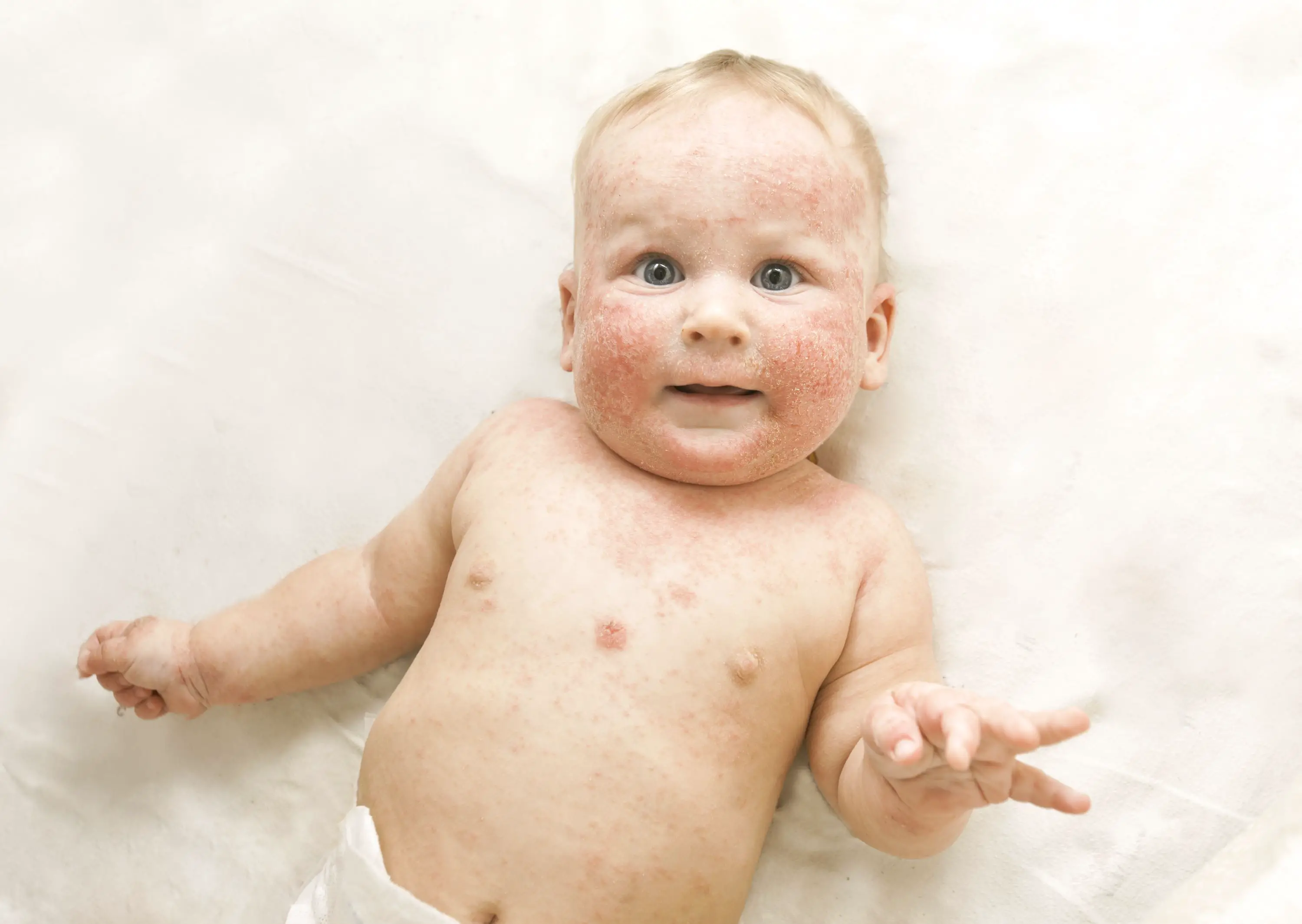 Simple Ways To Prevent Cradle Cap On Your Baby